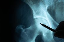 交通事故股骨骨折几级伤残